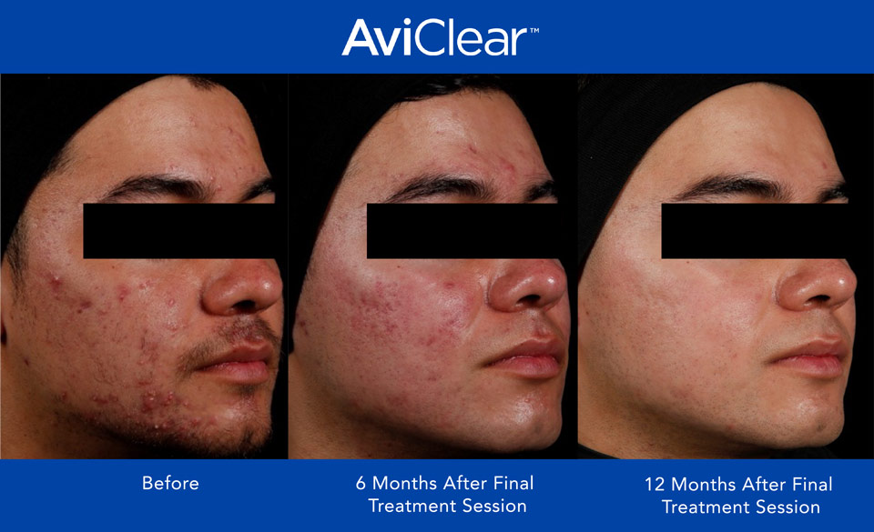 Before and after of face with acne, after 12 months of AviClear treatment