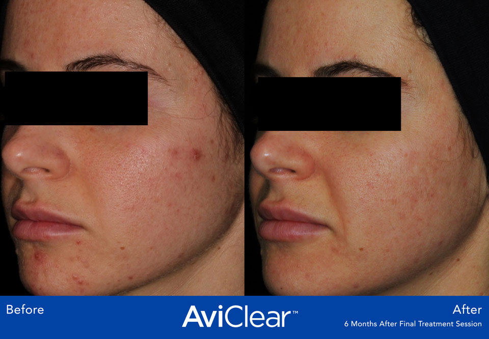 Before and after of face with acne, after 6 months of AviClear treatment