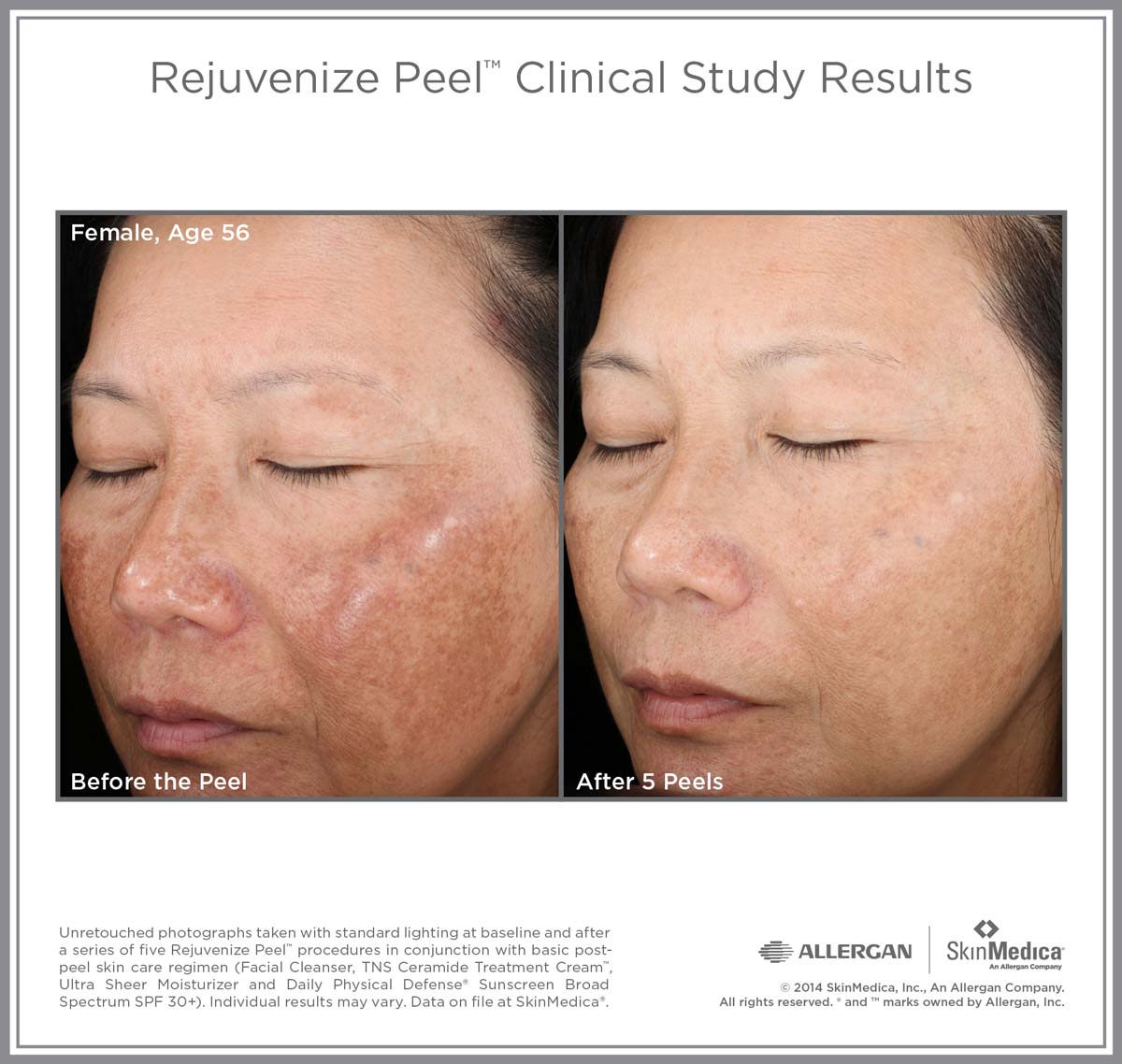 Rejuvenize Peel Clinical Study Results for Female age 56