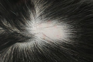 Alopecia (Hair Loss)