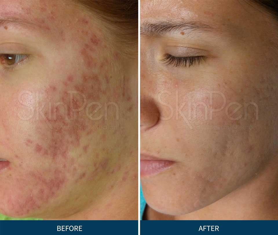 Before and after of acne scars, after six treatments of SkinPen Microneedling
